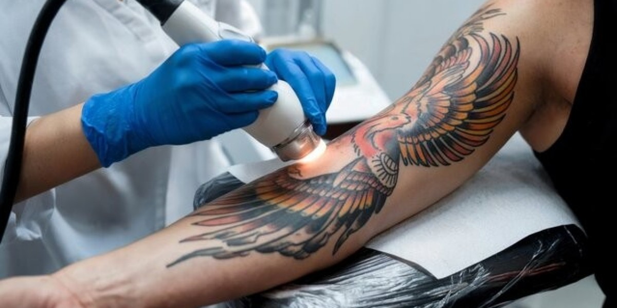 Safe and Effective Tattoo Removal Treatment in Ahmedabad – Ahmedabad Ink Tattoo