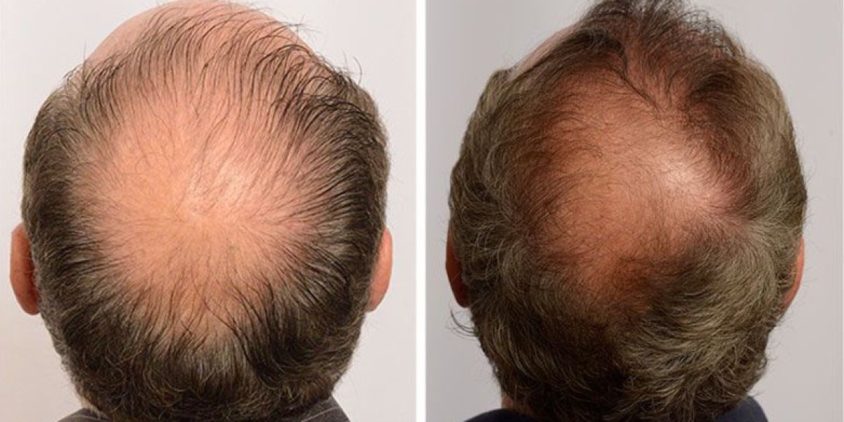 Stem Cell Hair Treatment NYC: Advanced Solution for Hair Loss