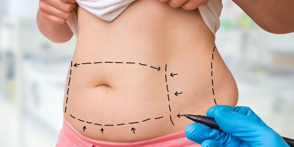 Best Clinic for Liposuction in Riyadh – Book Now