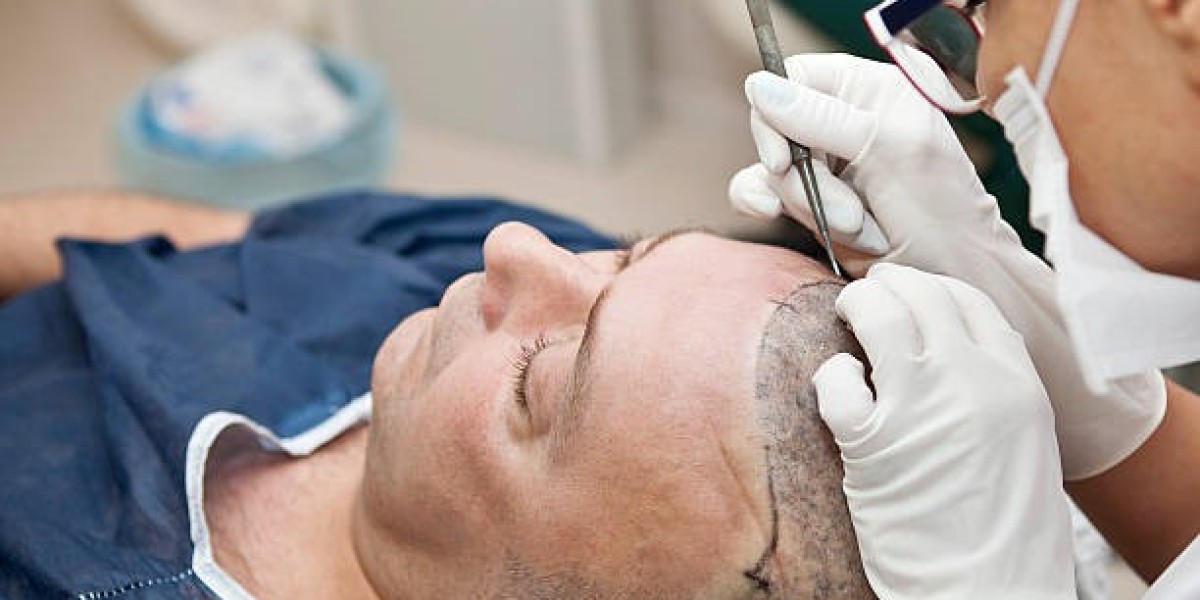 Hair Transplant Trends Shaping the Future of Hair Restoration Now