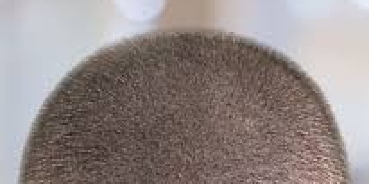 Understanding Donor Area in FUE Hair Transplant Extraction Process