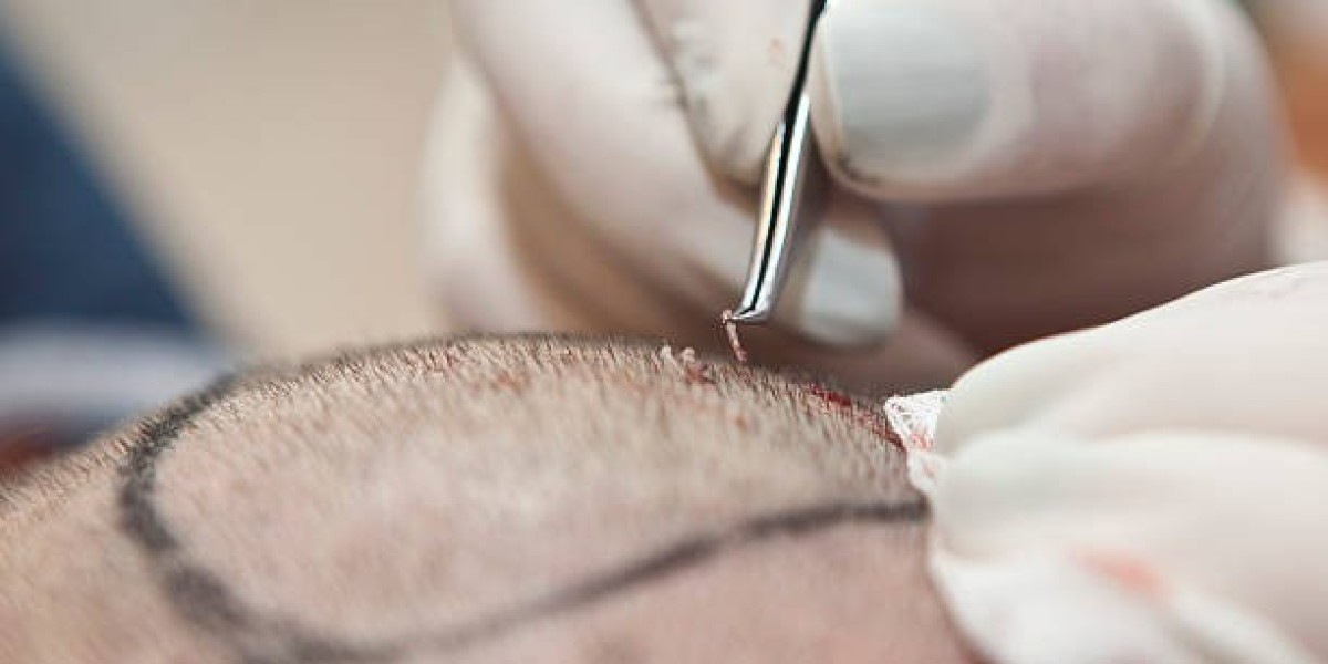 Hair Transplant for Scarring Alopecia: Hopeful Paths to Recovery